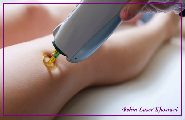 مراقبت های پس از لیزر موهای زائد در اصفهان