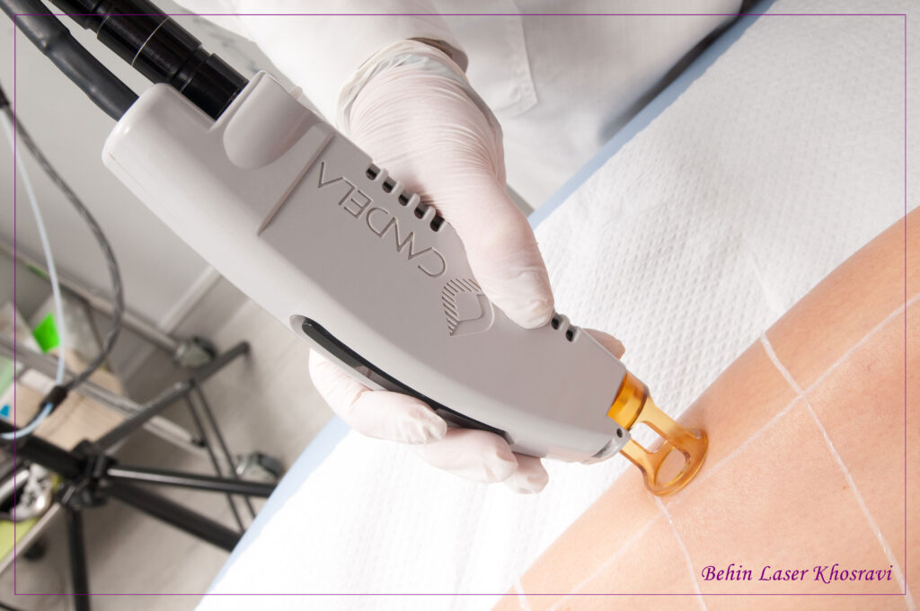 مزیت لیزر موهای زائد در اصفهان